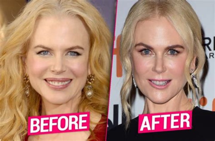 Nicole Kidman's Transformation: Before And After Fillers