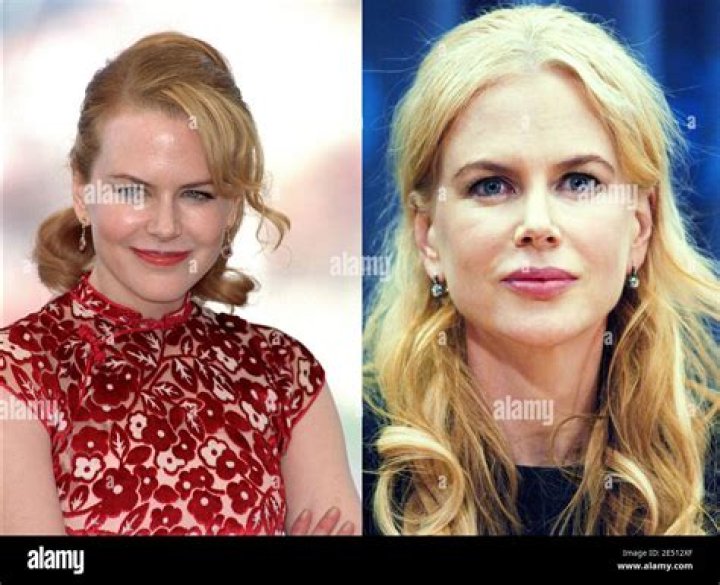 Nicole Kidman Breast Augmentation Truth Revealed