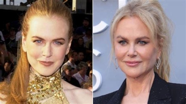 The Truth Uncovered: Cosmetic Surgery Rumors Surrounding Nicole Kidman